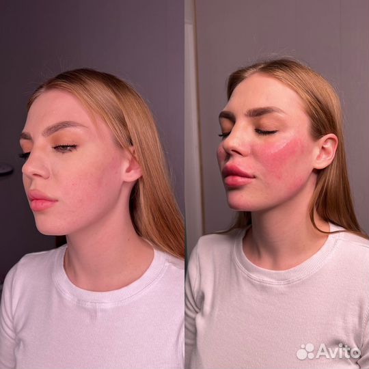 Требуются модели. Контурная пластика лица. Губы