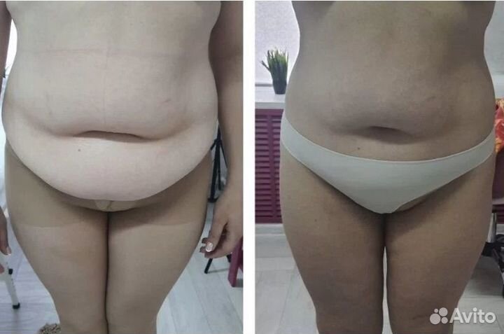 Сжигание жира без диет. Криолиполиз