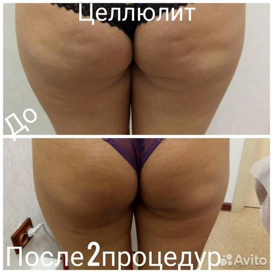 Похудение. Безоперационная липосакция. Целлюлит