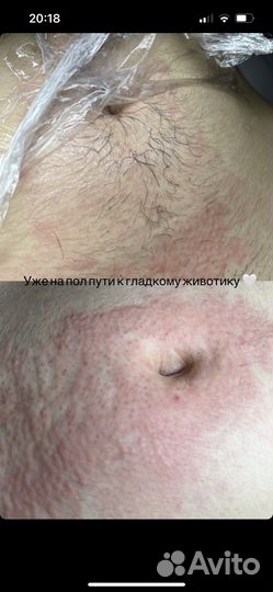 Электроэпиляция