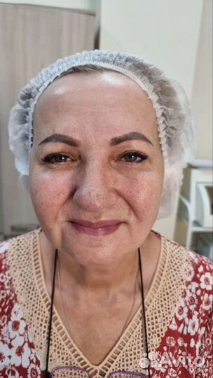 Релатокс, Ботокс