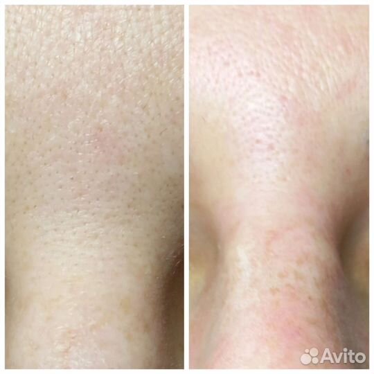 Безъиньекционная уходовая косметология