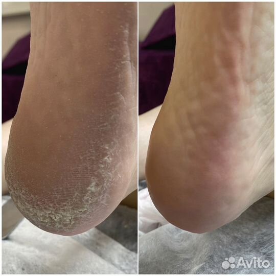 Коррекция вросшего ногтя