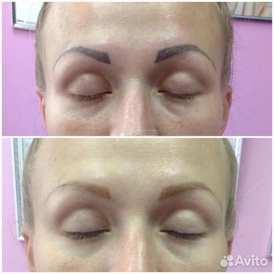 Удаление татуажа лазером, удаление тату