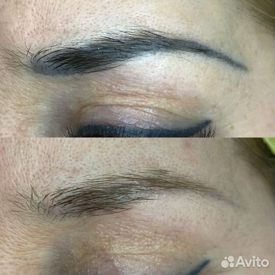 Удаление татуажа бровей модель