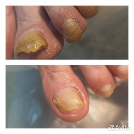 Подолог(сложные ноги,трещины,вросший но