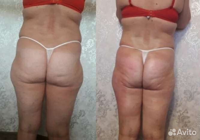 Коррекция фигуры: липосакция, кавитация и массажи