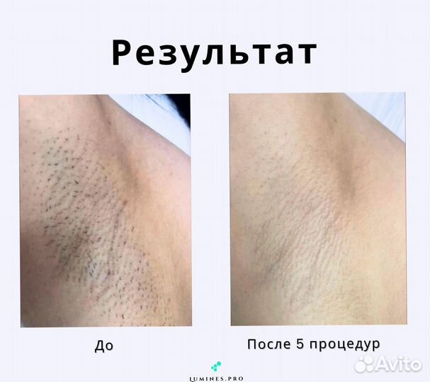 Диодный лазер Лю’минес Max One 1200 Вт