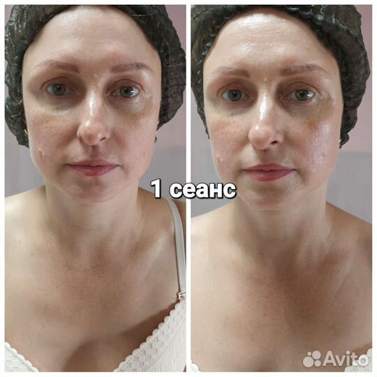 Массаж лица,Рф лифтинг лица.Микротоки