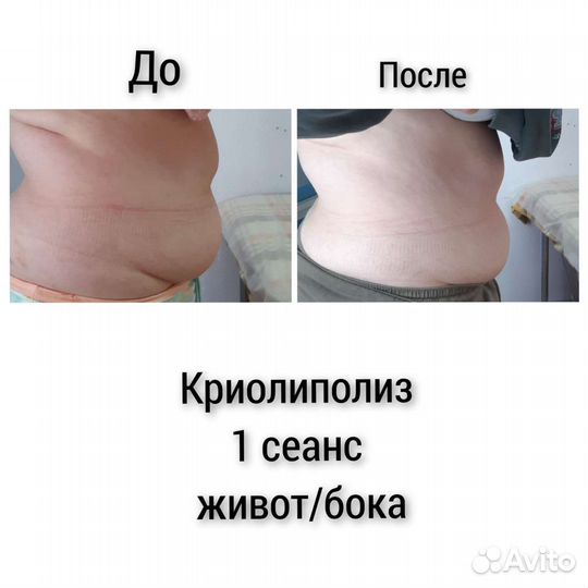 Криолиполиз