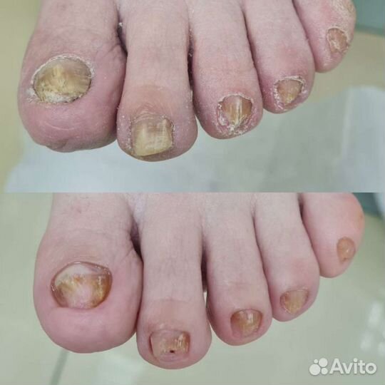 Подологическая обработка стопы, подолог