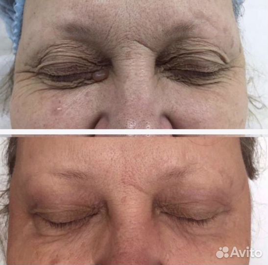 Лечение угревой сыпи