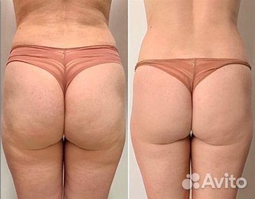 Модель на эндосферу тела / аппаратный массаж