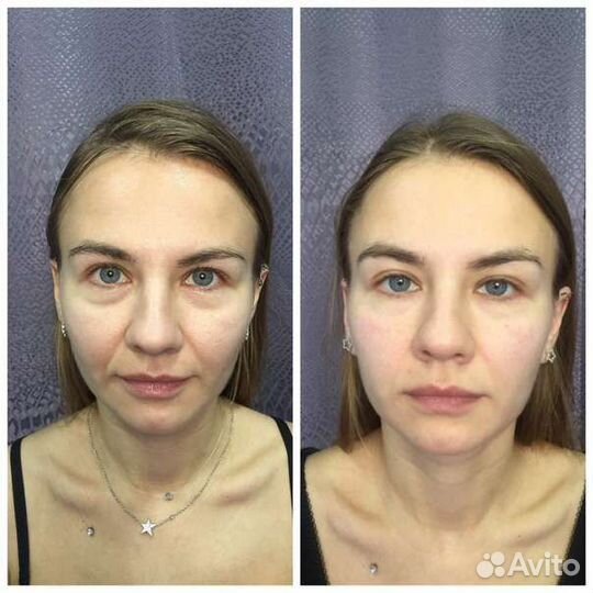 Скульптурный массаж лица