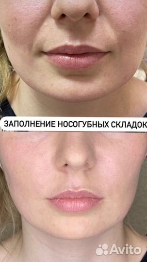 Увеличение Губы.Ботокс.Чистка лица