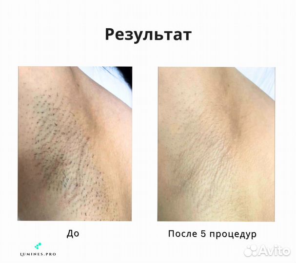 Диодный лазер для эпиляции Люминес’ макспро 2000 Вт