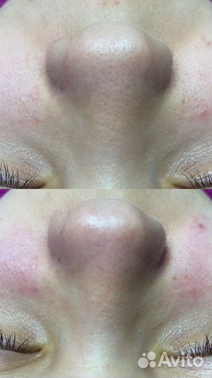 Пилинг лица фруктовыми кислотами