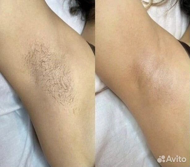 Депиляция воском