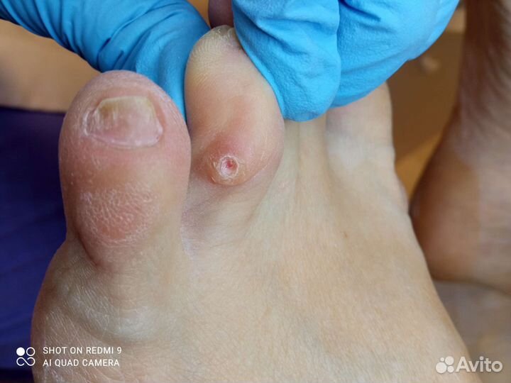 Педикюр медиц/маникюр/титановая нить/массаж