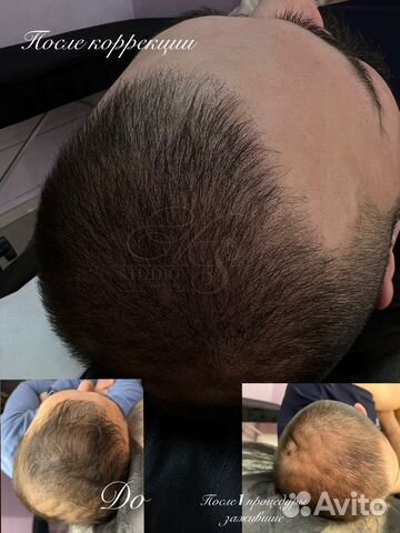 Трихопигментация SMP головы