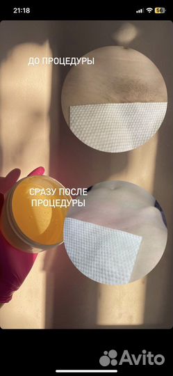 Шугаринг депиляция