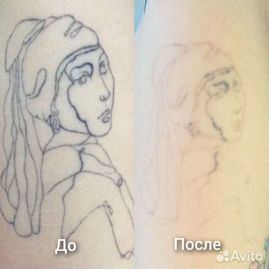 Лазерное удаление тату