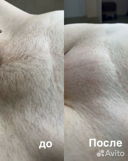 Шугаринг депиляция