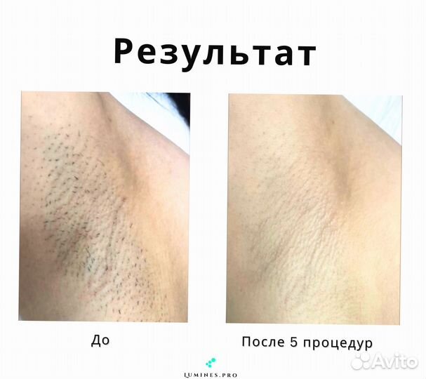 Аппарат для эпиляции Лю’минес Max’One 1200