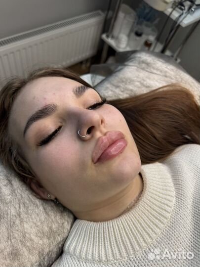 Увеличение губ,биоревитализация,мезотерапия