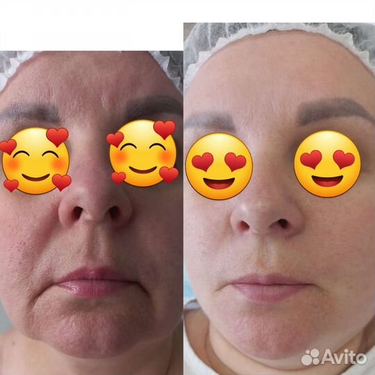 Вакуумный массаж, кавитация, рф+мои ручки