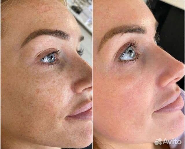 Мезотерапия в сети студий Skine Line