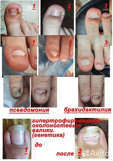 Педикюр, подолог (вросшие ногти, трещины пяток)