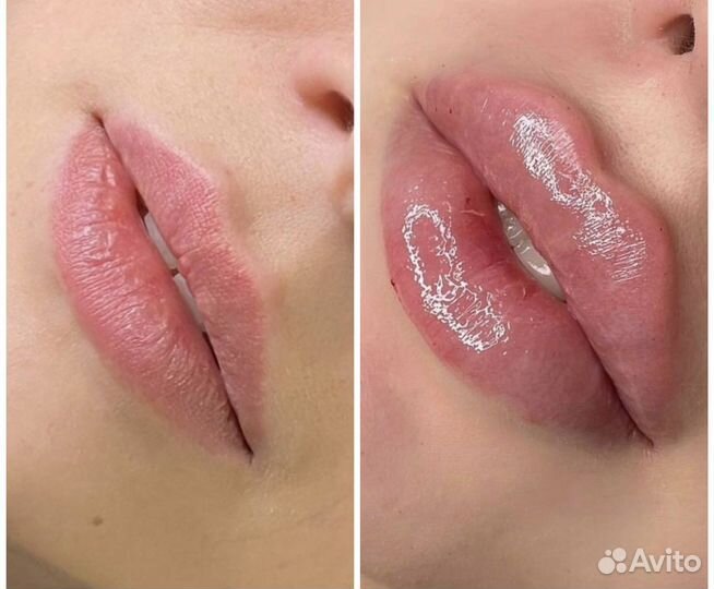 Увеличение губ