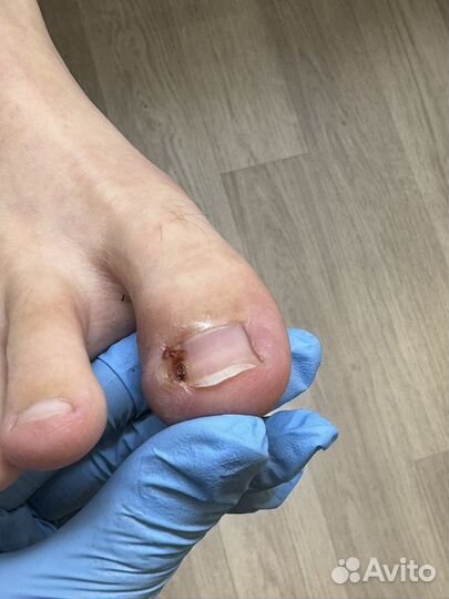 Вросший ноготь