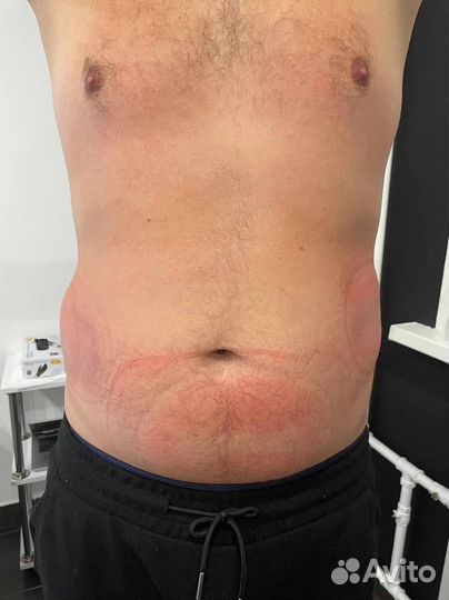 Криолиполиз похудение липосакция для мужчин