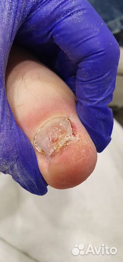 Аппаратный педикюр