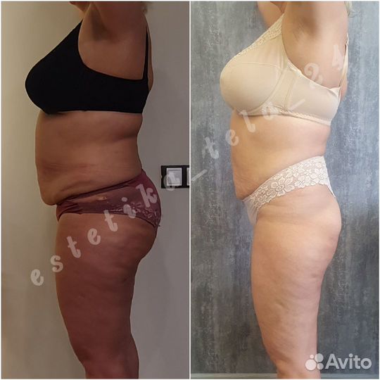 LPG массаж, аппаратная коррекция фигуры