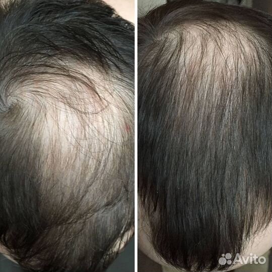 Восстановление и увеличение роста волос