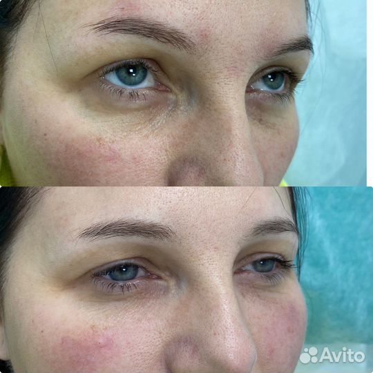 Ботокс/ Ботулинотерапия