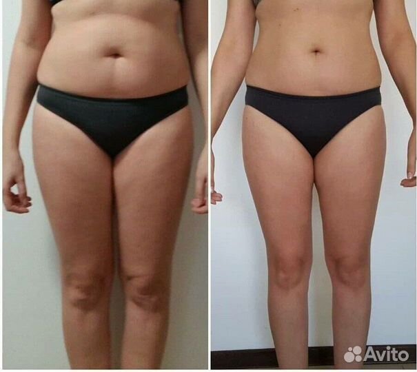 LPG массаж,вакум-массаж,кавитация, РФ - лифтинг