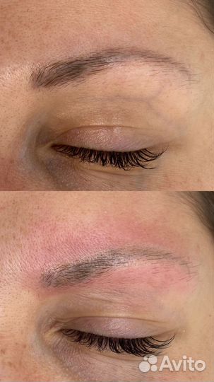 Лазерное удаления тату/татуажа/ /обучение/ модели