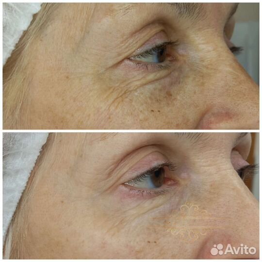 Процедуры холодной плазмы