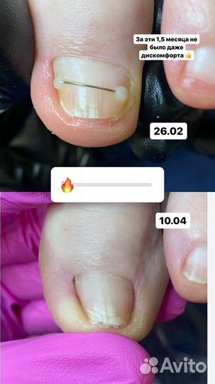 Подологический педикюр