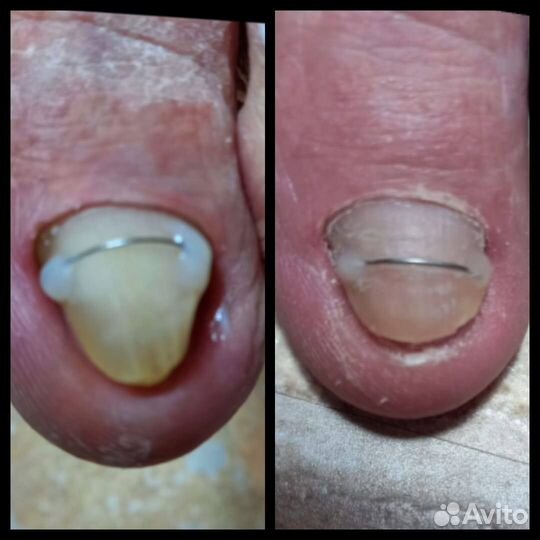 Подолог, лечебный педикюр