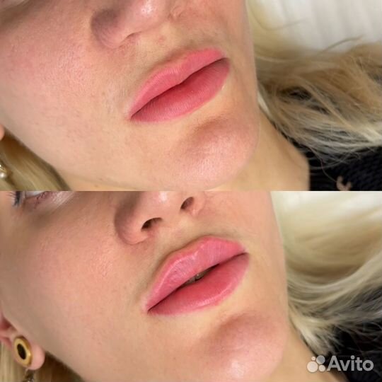 Косметолог: Губы, липолитики, мезотерапия, ботокс