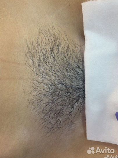 Шугаринг, восковая депиляция, эпиляция