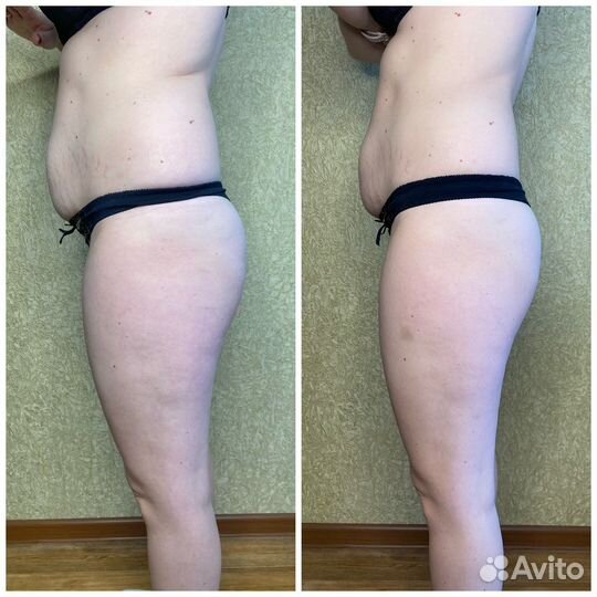 Антицеллюлитный массаж