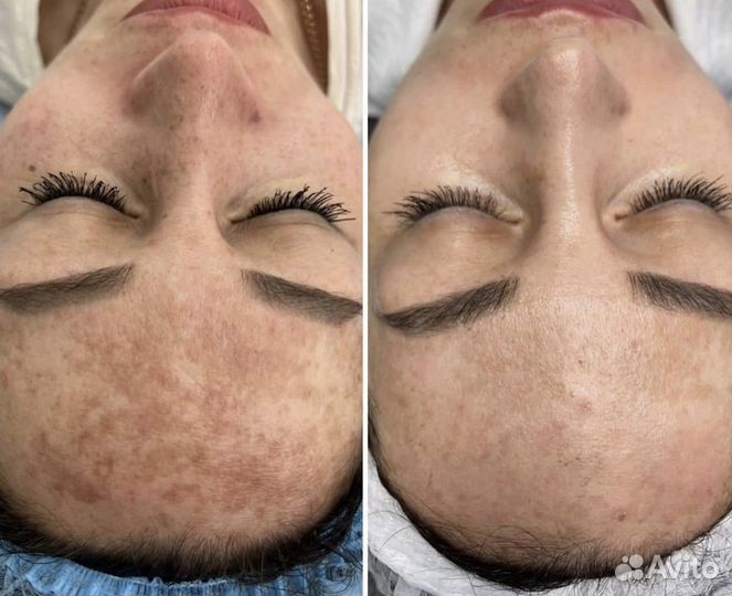 Фототерапия на аппарате М22