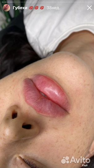 Увеличение губ