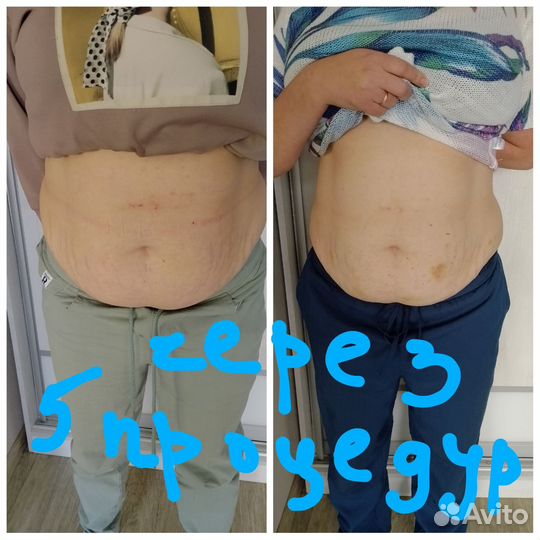 Аппаратная коррекция фигуры. Косметология